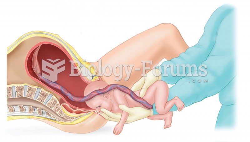 A breech birth. This image illustrates a newborn that has been delivered buttocks first. 