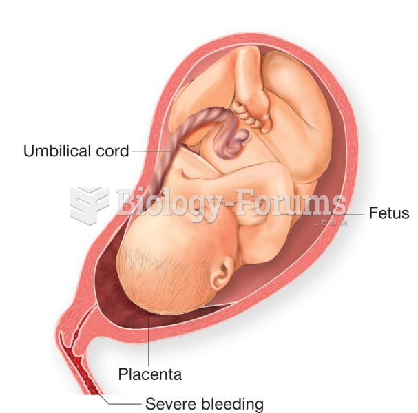 Placenta previa, longitudinal section showing the placenta growing over the opening into the cervix.