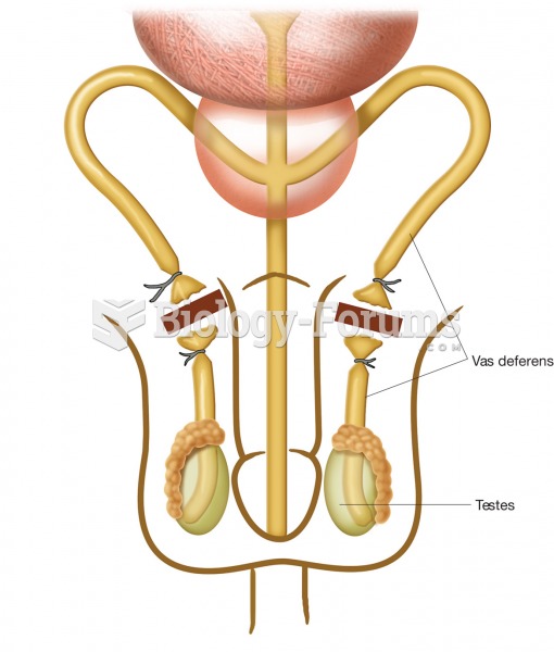 A vasectomy, showing how each vas deferens is tied off in two places and then a section is removed f