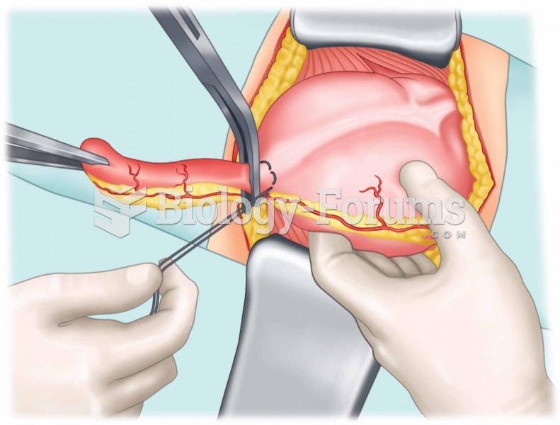 Appendectomy. The appendix and cecum are brought through the incision to the surface of the abdomen.