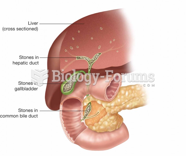 Gallbladder with gallstones. Note the stones in the hepatic duct, gallbladder, and common bile duct.