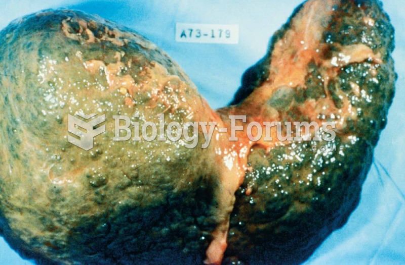 The liver in this photograph was from a deceased patient with an advanced state of cirrhosis. 