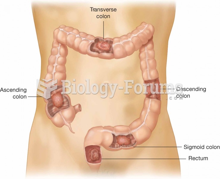 Common sites of colorectal cancer.