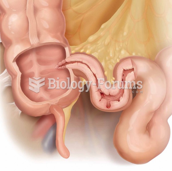 Note the thickening of the intestinal wall and the erosion of the inner lining of the ileum, often s