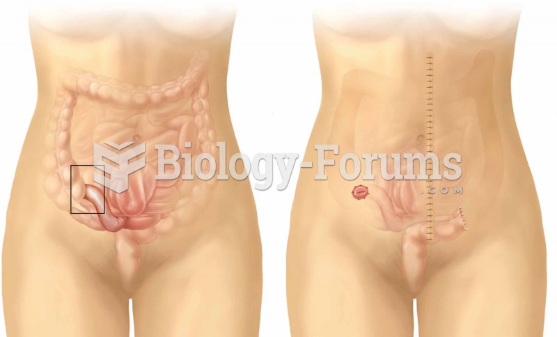 Ileostomy. Note that the cecum and colon have been surgically removed.