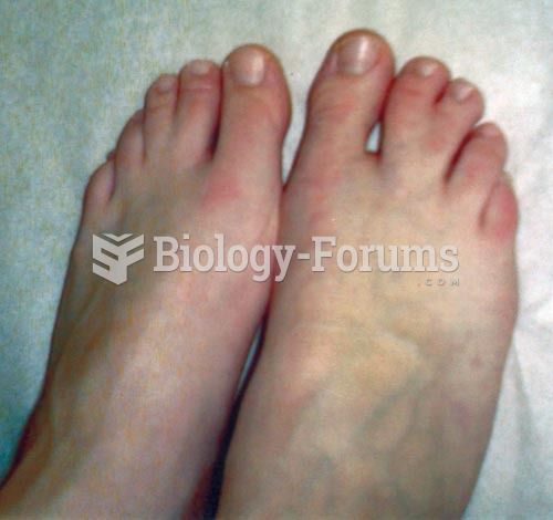 Toe Abnormalities: Syndactyly in the 2nd and 3rd Metatarsals of the Right Foot