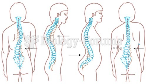 Abnormalities of the Spine, Scoliosis, Kyphosis, Lordosis, List