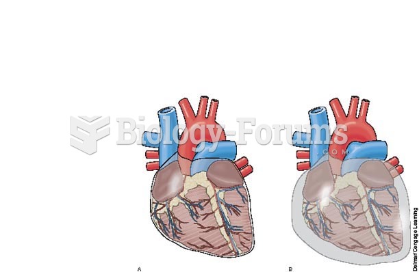 Pericardial effusion: A, normal pericardial sac; B, pericardial sac with excess fluid possibly causi