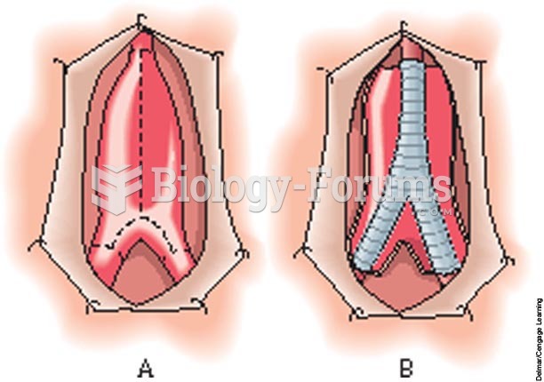 A, Aortoiliac aneurysm; B, bifurcated synthetic graft.