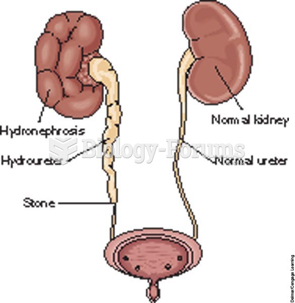 Hydronephrosis and hydroureter resulting from a stone in the ureter.