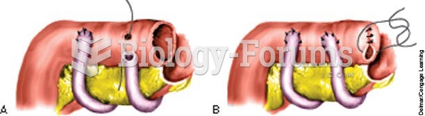 Ileal conduit; A, ureters implanted into ileal segment; B, closure of proximal end of ileal conduit.