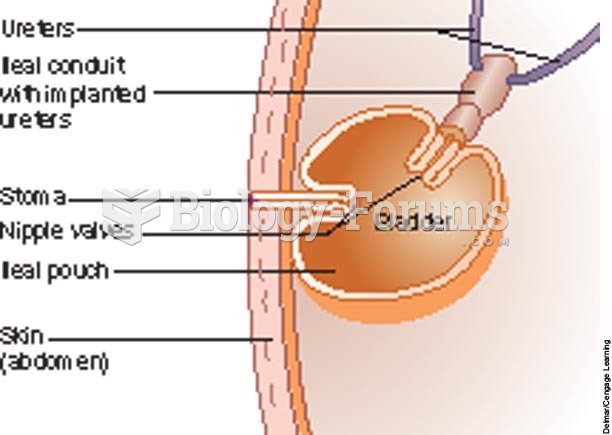 Urinary diversion – Koch pouch.