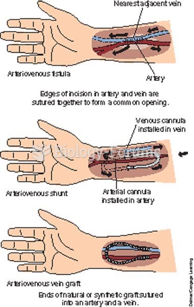 Types of hemodialysis access sites.