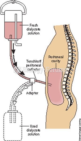 Peritoneal dialysis setup.