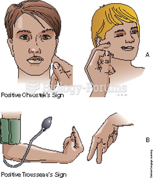 Signs of hypocalcemia and hypoparathyroidism; A, Chvostek's sign; B, Trousseau's sign.