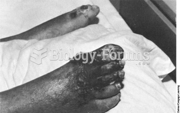 Gangrene of the toes and foot as a result of an infection often means eventual amputation.