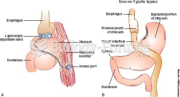 Types of bariatric surgery; A, laparoscopic adjustable gastric banding; B, Roux-en-Y gastric bypass.