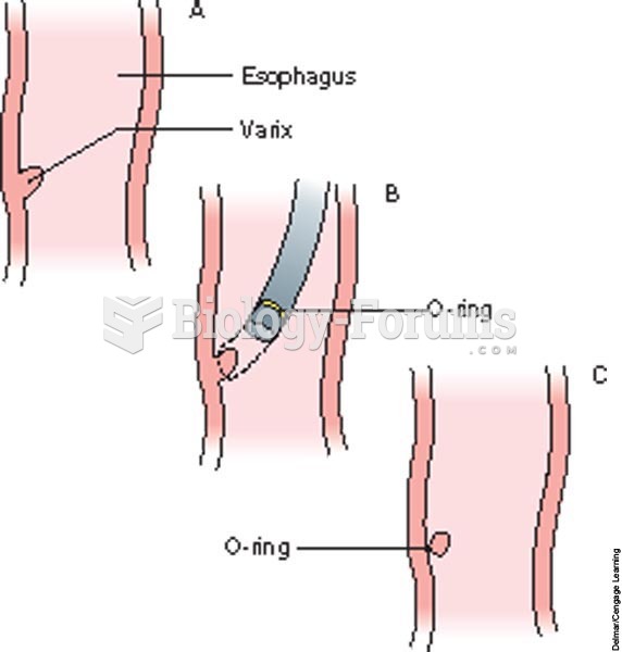 Banding of an esophageal varix; A, varix; B, insertion of tube with O-ring; C, O-ring is placed arou