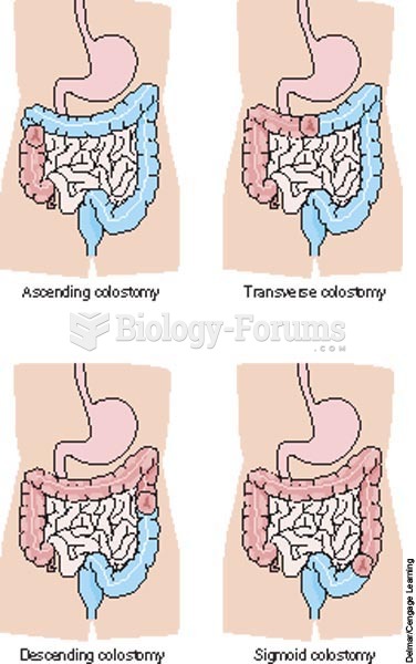 Colostomy sites (blue area is where colon was removed).