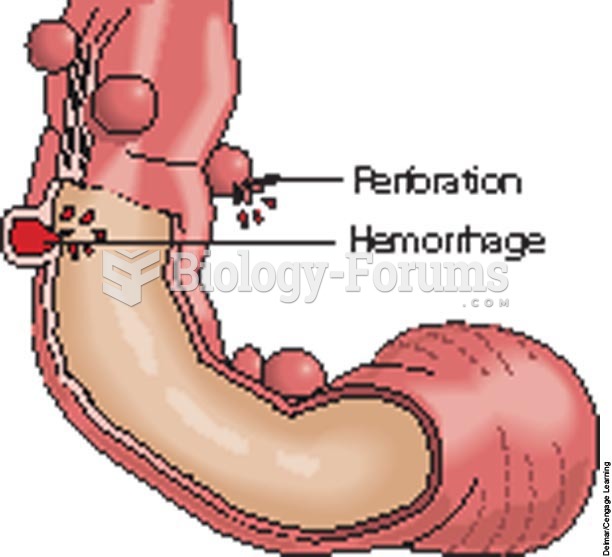 Diverticula in the sigmoid colon. Diverticulosis is almost always located in the descending or sigmo