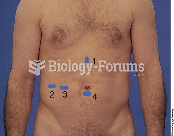 Four entry sites for laproscopic cholecstectomy.