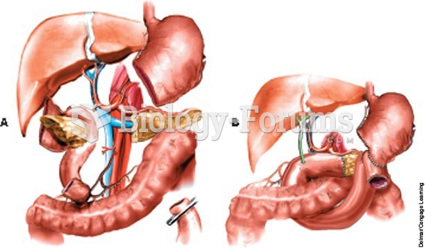 Whipple procedure (pancreatoduodenectomy)