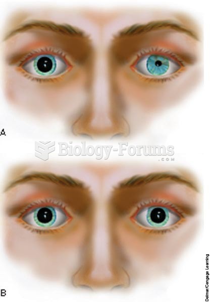 A, Unequal pupils; B, dilated, fixed pupils.