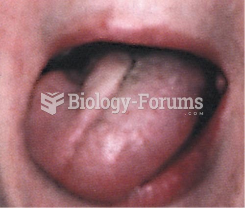 Tongue Conditions, Cranial Nerve XII (Hypoglossal) Palsy