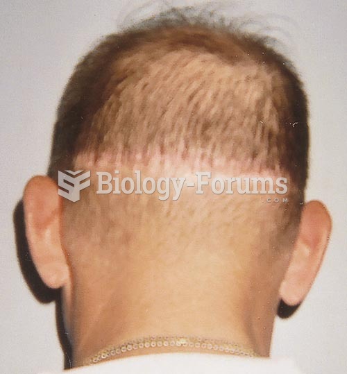 Linear alopecia developed in this man from daily wearing of his military uniform cap
