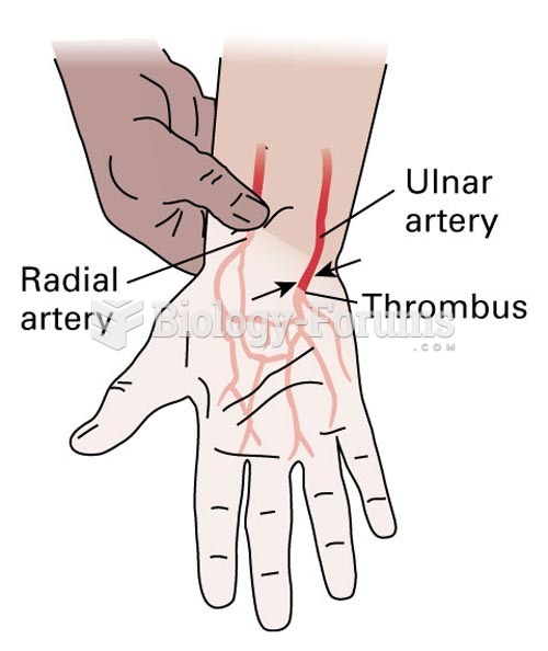 Allen Test: An occluded ulnar artery results in continued pallor of the hand while the radial artery