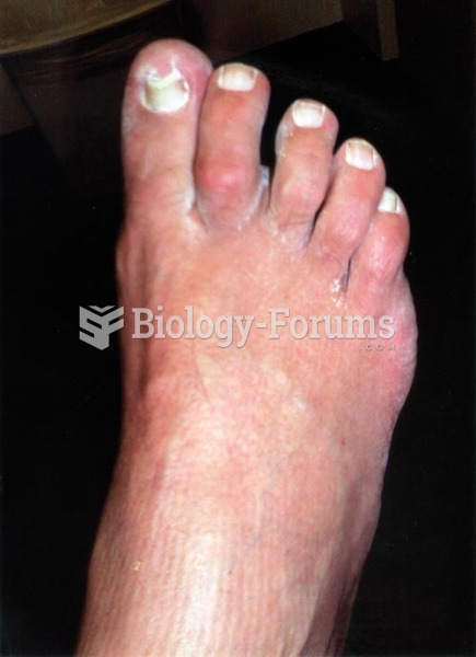 Joint Inflammation of Gout
