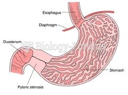 Pyloric Stenosis Symptoms