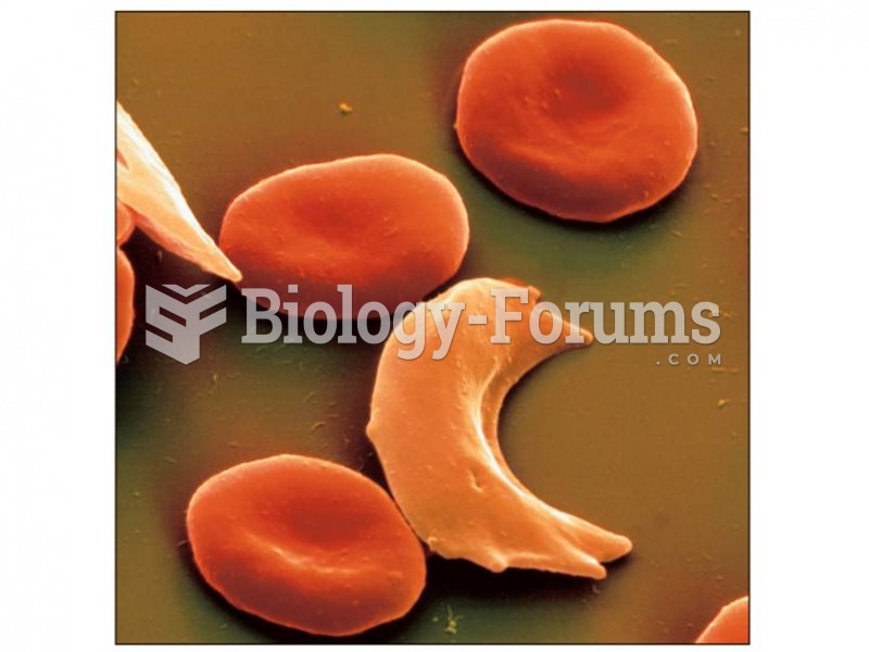 Comparison of normal and sickle cell red blood cells. 