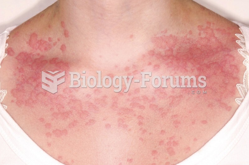 Allergies: Hives
