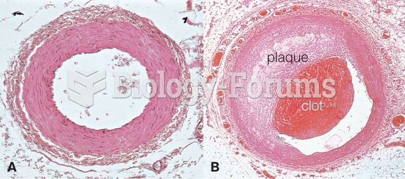 An Atherosclerotic Plaque