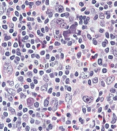 Hodgkin's Lymphoma