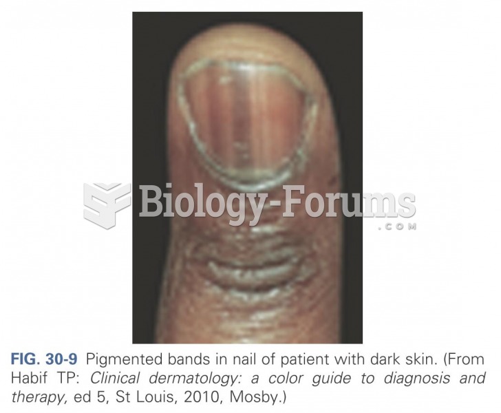 Pigmented bands in nail of patient with dark skin