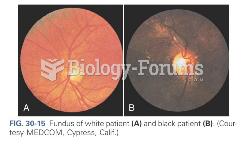 Fundus of white pateint and black patient