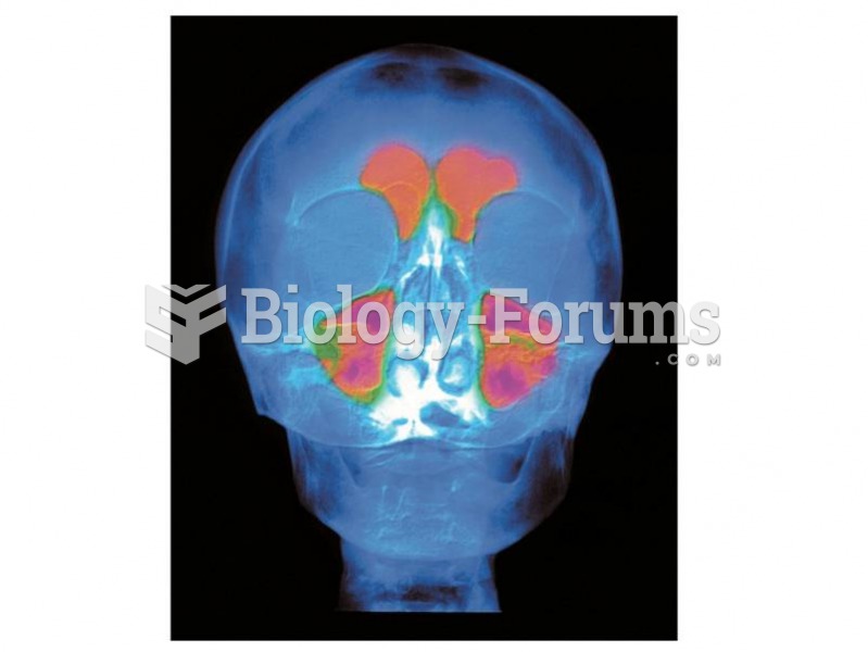 The frontal sinus, an airfilled space just behind the brow, is a unique size and shape in each of us