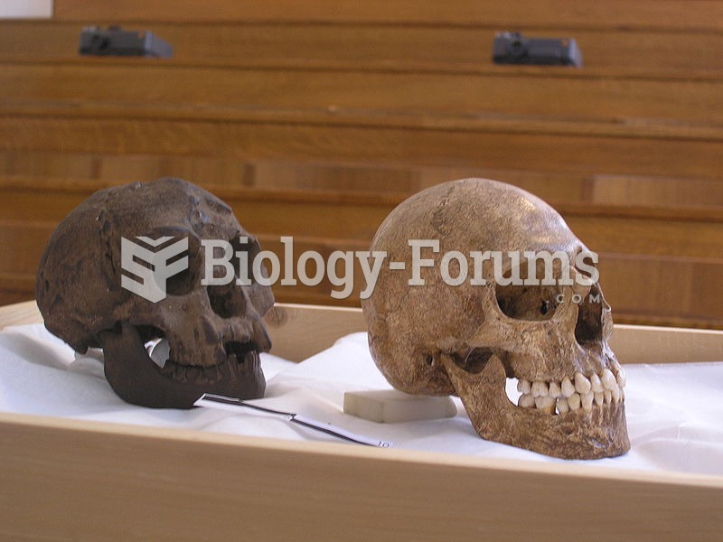 A cast of LB1 (left) was compared to several microcephalic skulls, amongst which is that of the micr