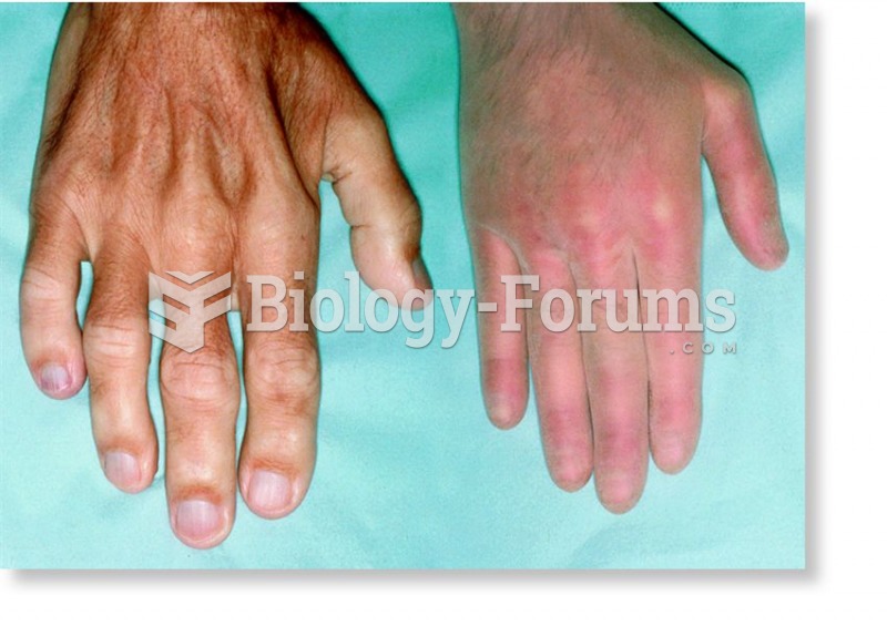 Acromegaly in one individual from a pair of identical twins.