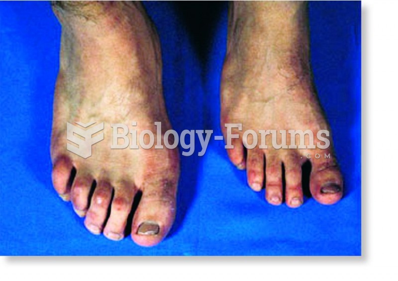 Acromegaly in one individual from a pair of identical twins.