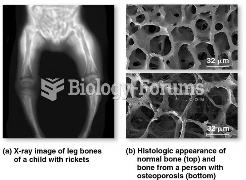 Deformation in human bones caused by (a) rickets and (b) osteoporosis.