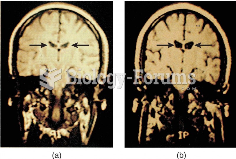 MRI Scans of the Brains of Twins Discordant for Schizophrenia