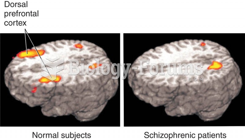 Hypofrontality in Schizophrenia 