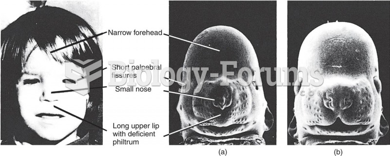 Facial Malformations in Fetal Alcohol Syndrome 