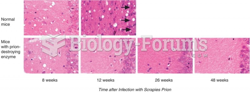 Experimental Treatment of a Prion Protein Infection 