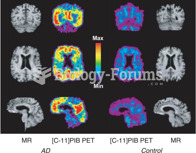 Detection of β-Amyloid Protein