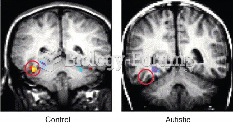 Fusiform Face Area and Autism 