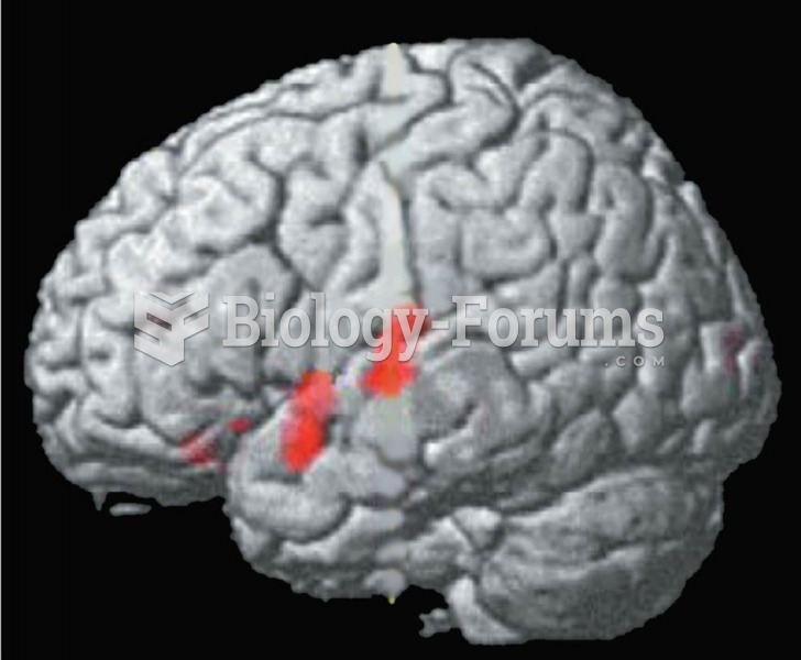 Effects of Therapy for Stuttering A functional MRI scan shows regions of the superior temporal lobe 